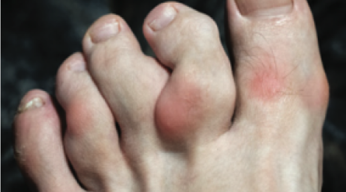 Close up of tophi in toes