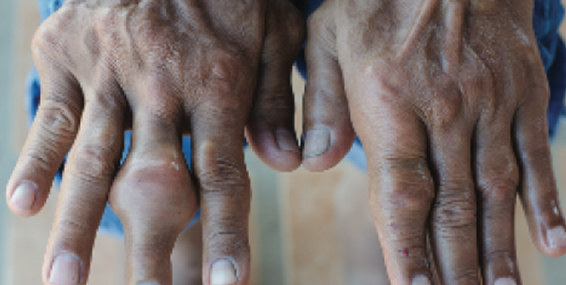 Side by side hands with tophi