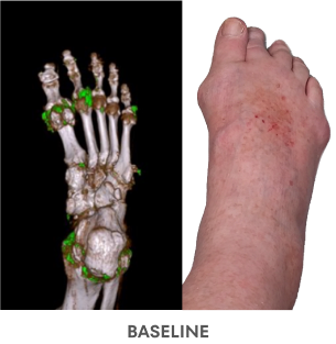 A series of Dual Energy Computed Tomography (DECT) scans before and after KRYSTEXXA with methotrexate treatment, from baseline to 6 months to 12 months, showing reduced uric acid deposits in a foot