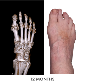A series of Dual Energy Computed Tomography (DECT) scans before and after KRYSTEXXA with methotrexate treatment, from baseline to 6 months to 12 months, showing reduced uric acid deposits in a foot