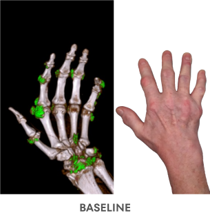 A series of Dual Energy Computed Tomography (DECT) scans before and after KRYSTEXXA with methotrexate treatment, from baseline to 6 months to 12 months, showing reduced uric acid deposits in a hand