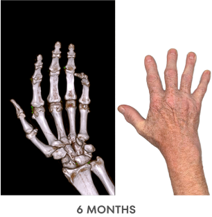 A series of Dual Energy Computed Tomography (DECT) scans before and after KRYSTEXXA with methotrexate treatment, from baseline to 6 months to 12 months, showing reduced uric acid deposits in a hand