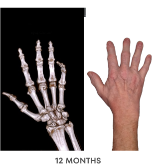 A series of Dual Energy Computed Tomography (DECT) scans before and after KRYSTEXXA with methotrexate treatment, from baseline to 6 months to 12 months, showing reduced uric acid deposits in a hand