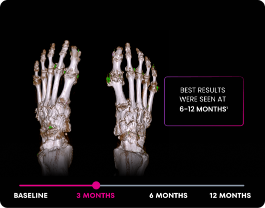 DECT image of uric acid deposits from gout in feet of KRYSTEXXA with methotrexate patient at 3 months