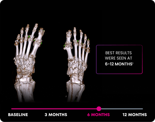 DECT image of uric acid deposits from gout in feet of KRYSTEXXA with methotrexate patient at 6 months