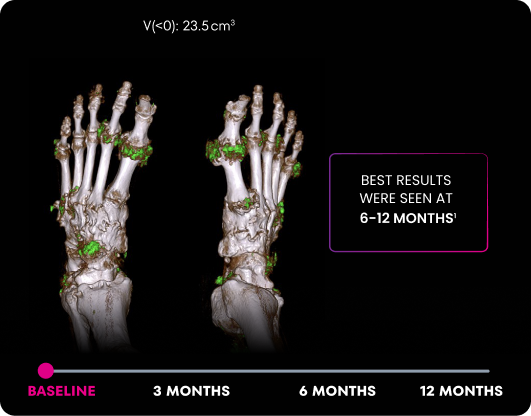 DECT image of uric acid deposits from gout in feet of KRYSTEXXA with methotrexate patient at baseline