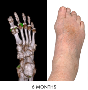 A series of Dual Energy Computed Tomography (DECT) scans before and after KRYSTEXXA with methotrexate treatment, from baseline to 6 months to 12 months, showing reduced uric acid deposits in a foot