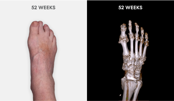  Photo showing no visible tophi in foot as well as no uric acid deposits in DECT scan after 52 weeks of treatment