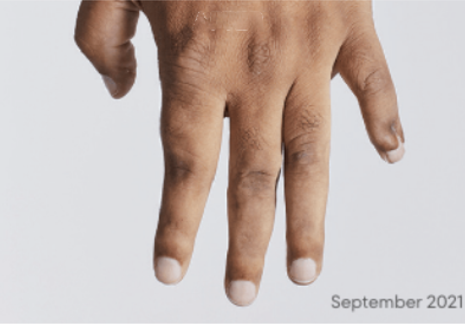 Image of no visible tophi in hand after KRYSTEXXA treatment 