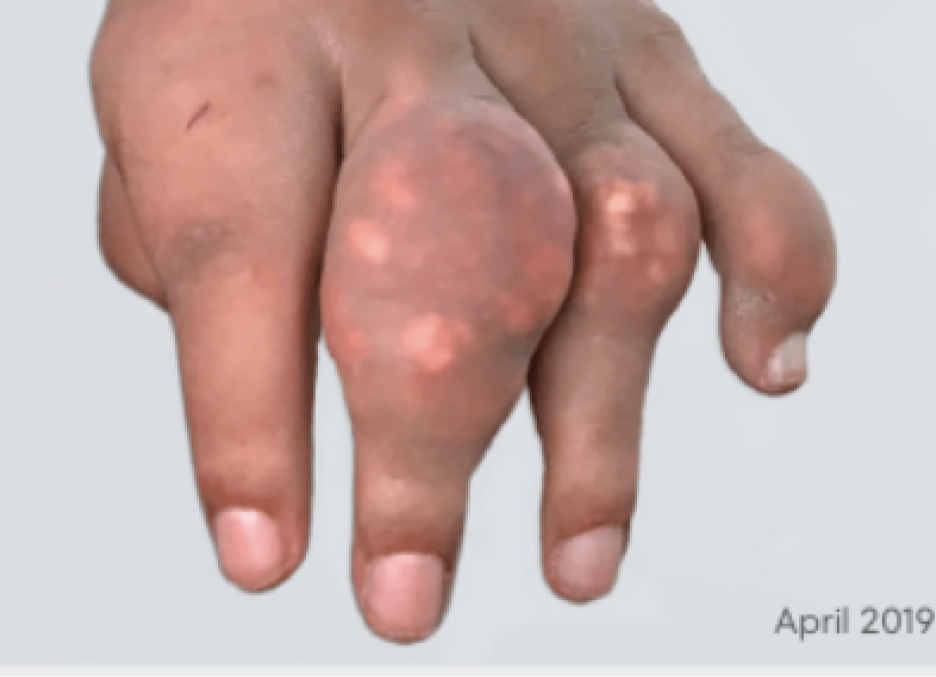 Image of visible tophi in hand before KRYSTEXXA treatment