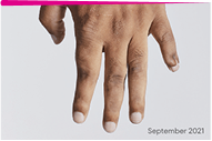  Image of no visible tophi in hand after KRYSTEXXA treatment 