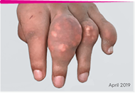Image of visible tophi in hand before KRYSTEXXA treatment