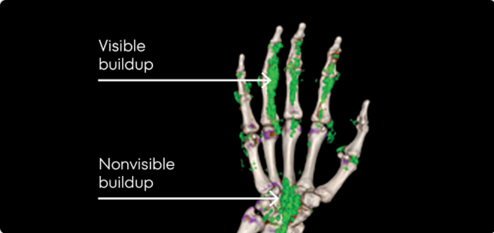 Dual Energy CT scan of hand showing visible and nonvisible buildup in gout patient