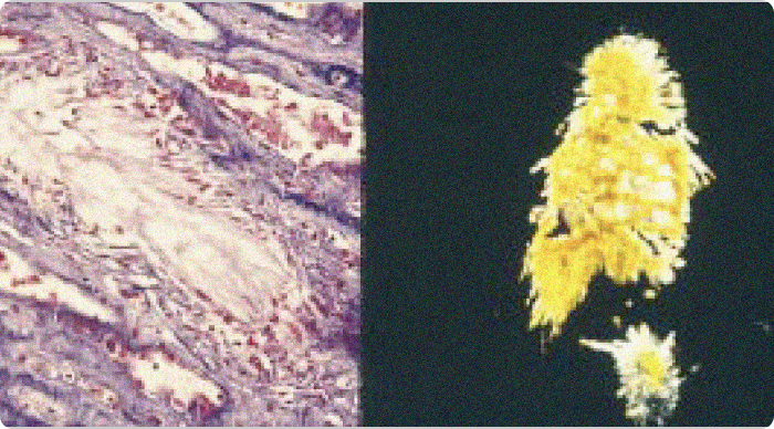 Side by side gouty tophi images