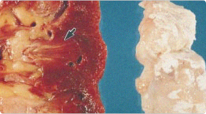 Images of gouty tophi in joint and kidney