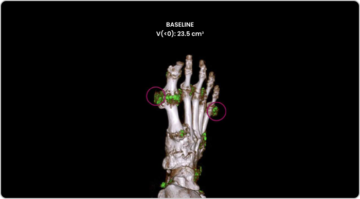 Dual Energy CT scan of uric acid buildup in foot at baseline