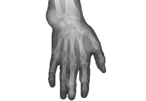 urate-crystal-slider-1