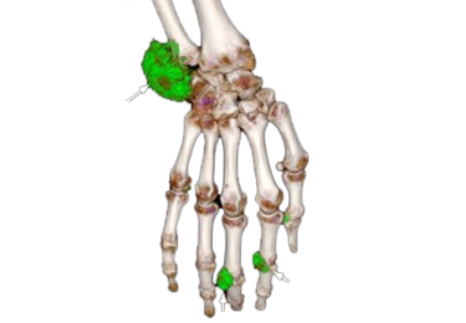 urate-crystal-slider-2