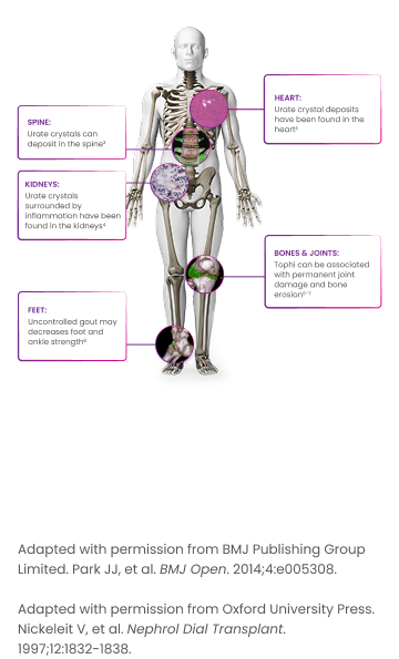 othrs-skeleton_rheum-mbl
