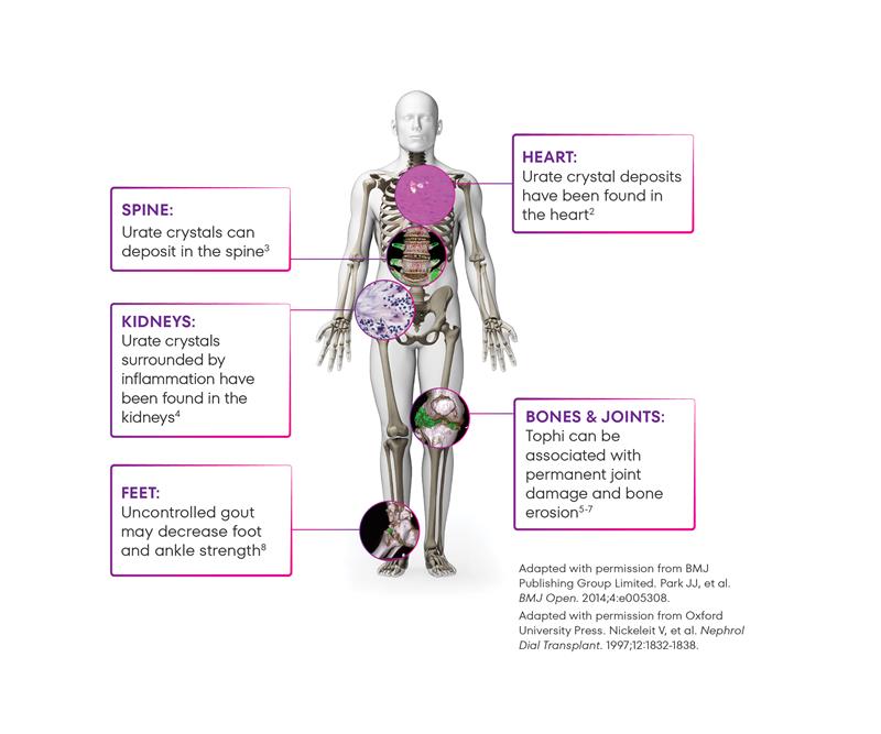skeleton_rheum