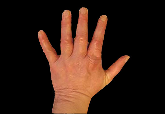 Deposition of uric acid in hand
