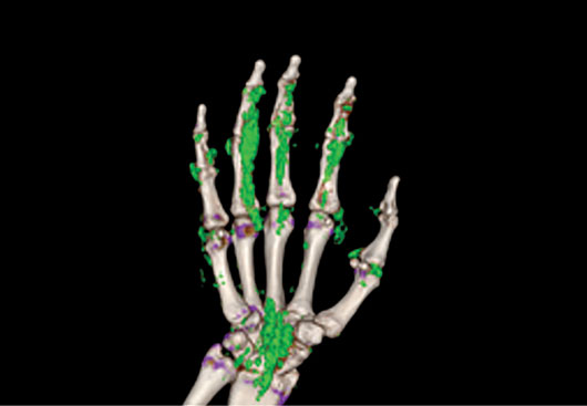 Deposition of uric acid in hand
