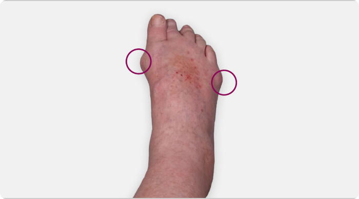 Foot tophi image