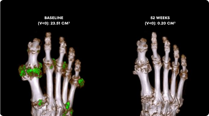 Side by side Dual Energy CT scans showing uric acid buildups in a gout patient at baseline and at Week 52 of treatment