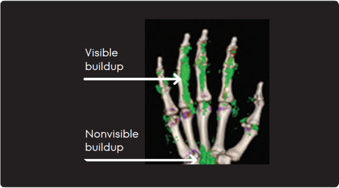 Dual Energy CT scan of hand showing visible and nonvisible buildup in gout patient