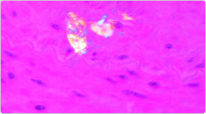 Micro tophus photo