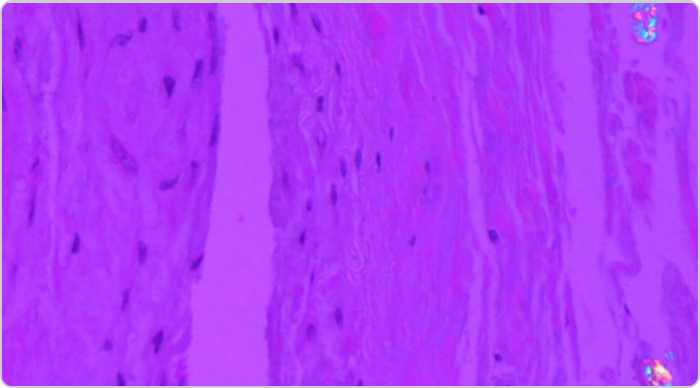 Micro tophi photo