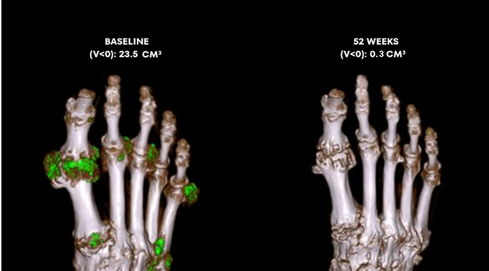 Side by side Dual Energy CT scans showing uric acid buildups in a gout patient at baseline and at Week 52 of treatment