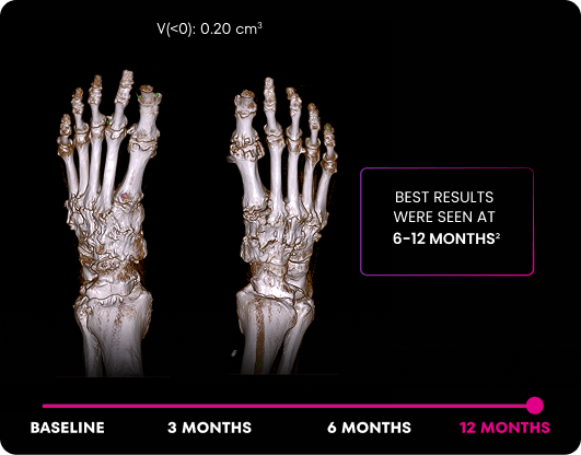 DECT image of uric acid deposits from gout in feet of KRYSTEXXA with methotrexate patient at 12 months