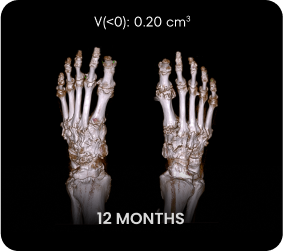 DECT image of uric acid deposits from gout in feet of KRYSTEXXA with methotrexate patient at 12 months