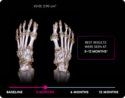 DECT image of uric acid deposits from gout in feet of KRYSTEXXA with methotrexate patient at 3 months