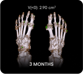 DECT image of uric acid deposits from gout in feet of KRYSTEXXA with methotrexate patient at 3 months