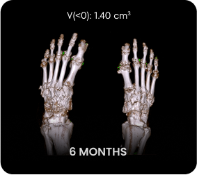 DECT image of uric acid deposits from gout in feet of KRYSTEXXA with methotrexate patient at 6 months