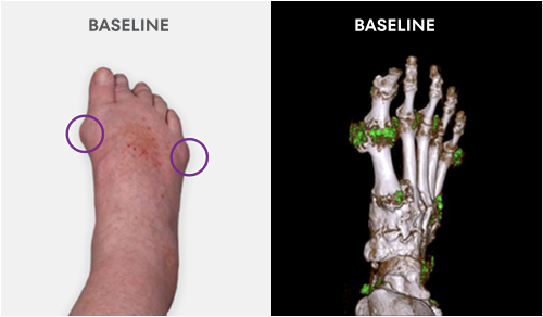 Baseline photo showing visible tophi in foot as well as uric acid deposits in DECT scan