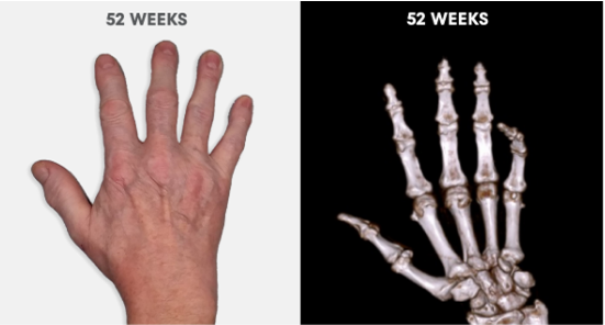  Photo showing no visible tophi in hand as well as no uric acid deposits in DECT scan after 52 weeks of treatment