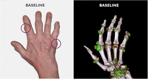Baseline photo showing visible tophi in hand as well as uric acid deposits in DECT scan