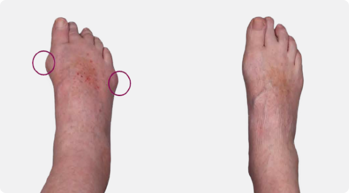 Side by side pictures of tophi on foot before and after KRYSTEXXA with methotrexate treatment