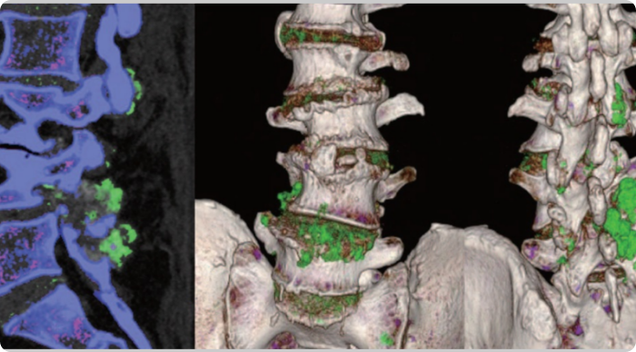DECT scans of lower spine showing tophaceous deposits 