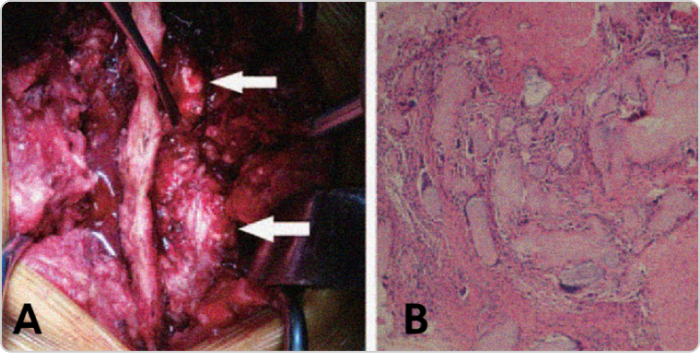 Photo of tophi from gout in spine