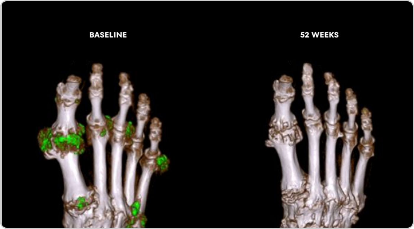 Side by side Dual Energy CT scans showing uric acid buildup in foot before and after KRYSTEXXA with methotrexate treatment
