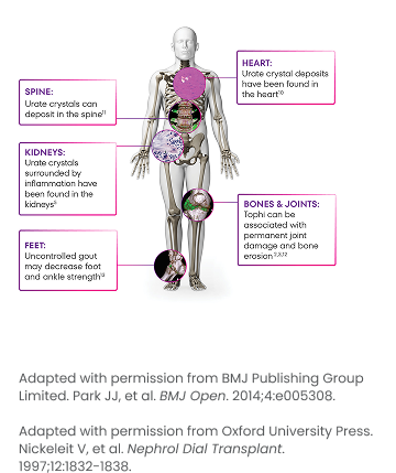 Graphic of urate deposits around the body including in the heart, spine, kidneys, feet, and bones.