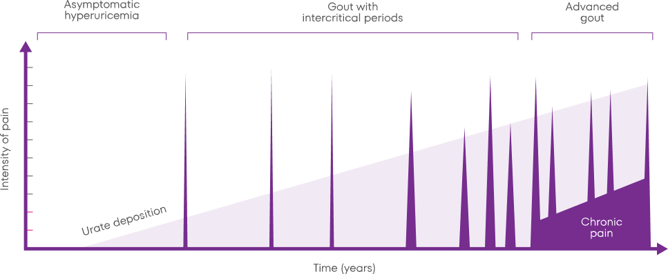 Time chart of gout progression from asymptomatic to advanced gout