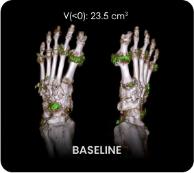 DECT image of uric acid deposits from gout in feet of KRYSTEXXA with methotrexate patient at baseline